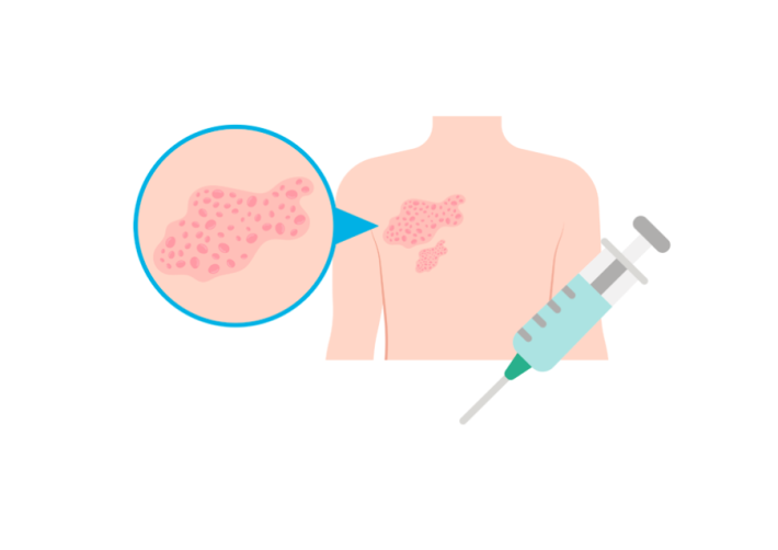 gordelroos vaccinatie